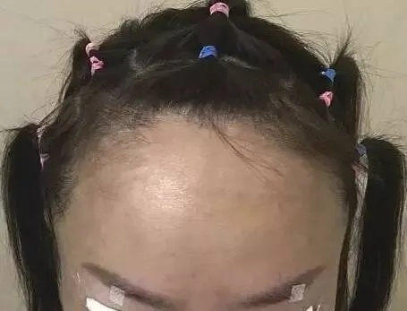 无需羞怯!发际线告别分离,拯救脱发烦恼,重拾自信迎接新生活