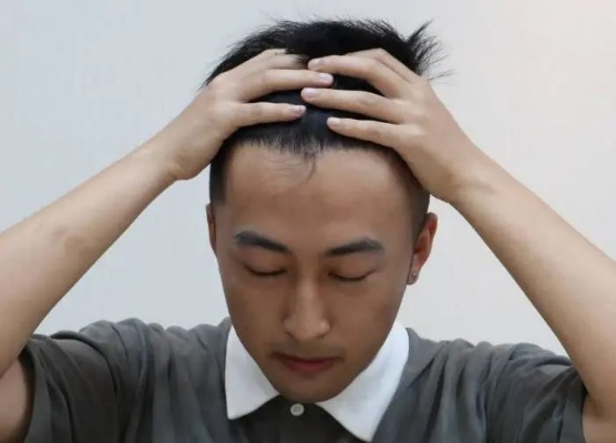 无需羞怯！发际线告别分离，拯救脱发烦恼，重拾自信迎接新生活