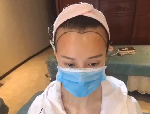 无需羞怯！发际线告别分离，拯救脱发烦恼，重拾自信迎接新生活